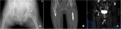Case report: Glucose 6-phosphate-isomerase deficiency combine with avascular necrosis of bilateral femoral head